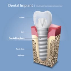 Dental Implants Boise Id