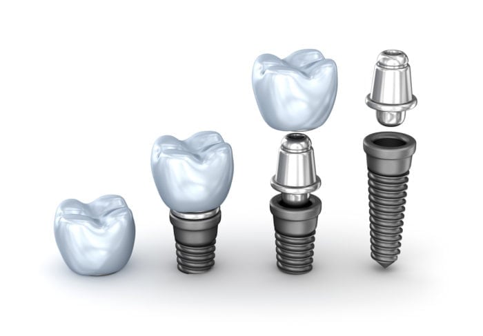 Cost of Dental Implants in Boise, ID