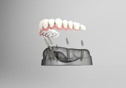 Dentures & Partials