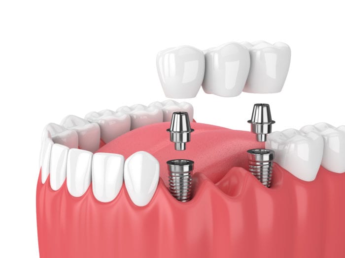 We offer Multiple Dental Implants in Boise, Idaho