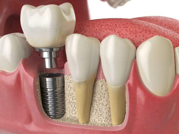 Dental Implant Process in Boise, Idaho