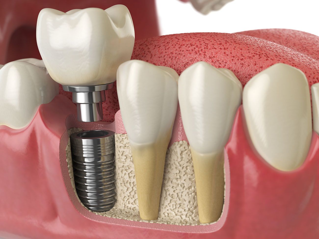 Why People Choose Dental Implants Dental Implants Boise ID
