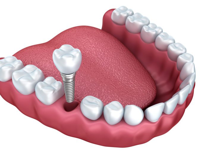 Single Dental Implant Boise, ID