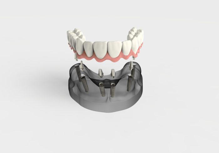 Implant Secured Dentures in Boise, ID