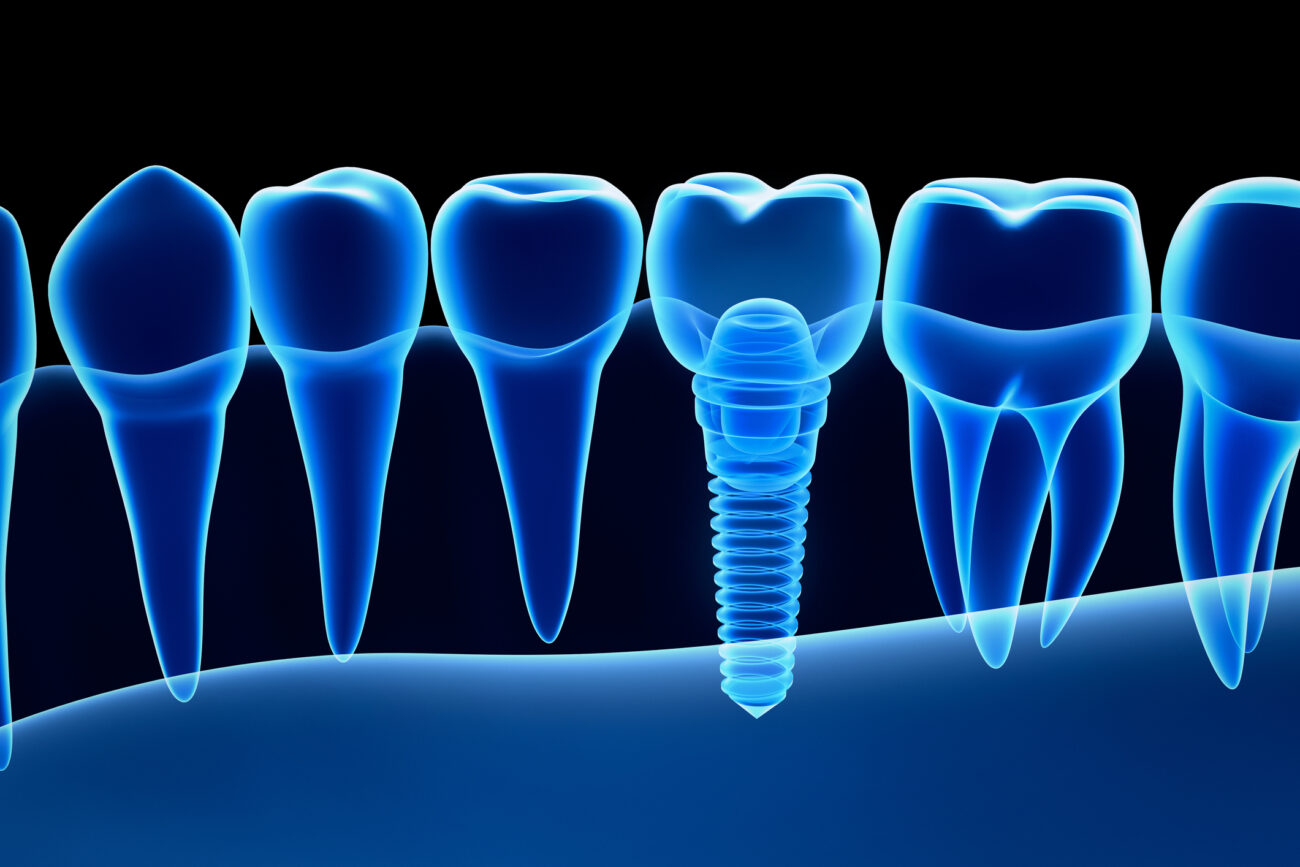 Dental Implants in Boise, Idaho