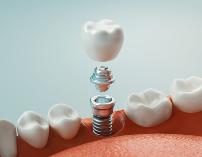 What You Didn't Know About Dental Implants