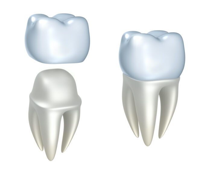 dental crowns in boise, id, need extra care and attention to last long