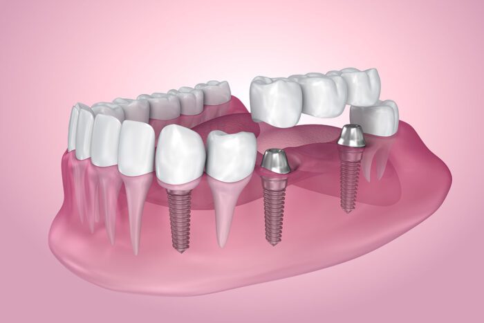 DENTAL IMPLANTS in BOISE ID are a great way to restore your bite after losing a tooth