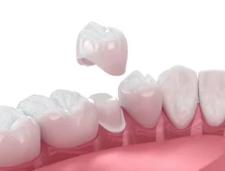 What Dental Crowns Are and Why They Matter in Boise, ID