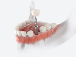 Replacing a Missing Tooth? The Dental Implant Process in Boise, ID